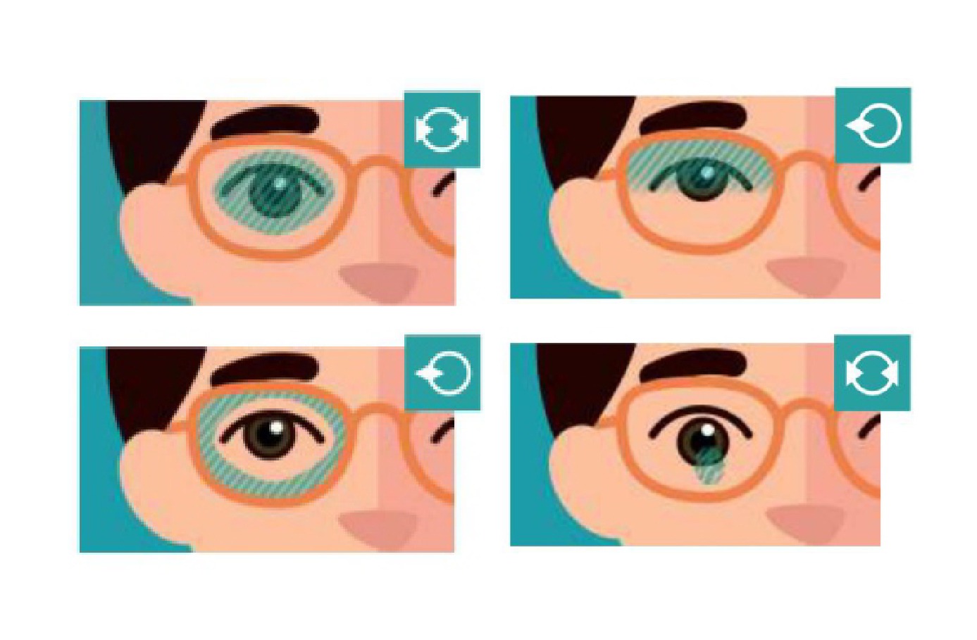 Controlling Myopia for Children
